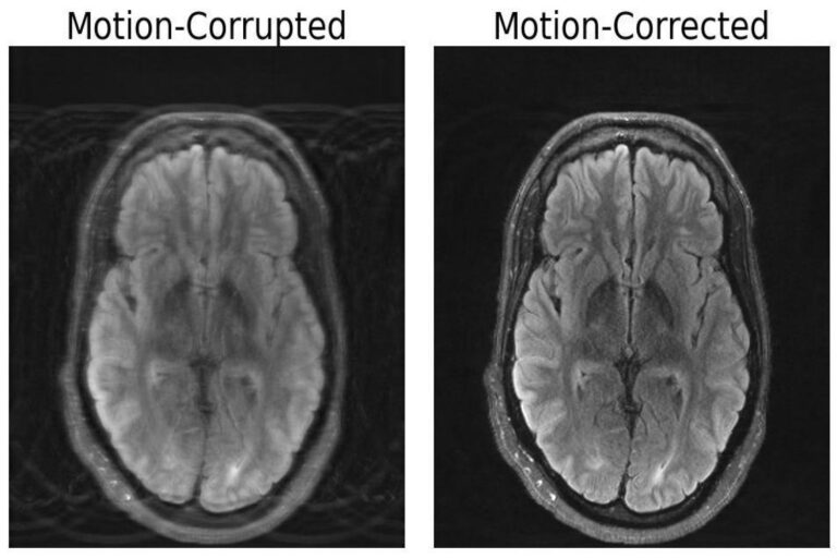 MIT researchers mix deep studying and physics to repair motion-corrupted MRI scans | MIT Information