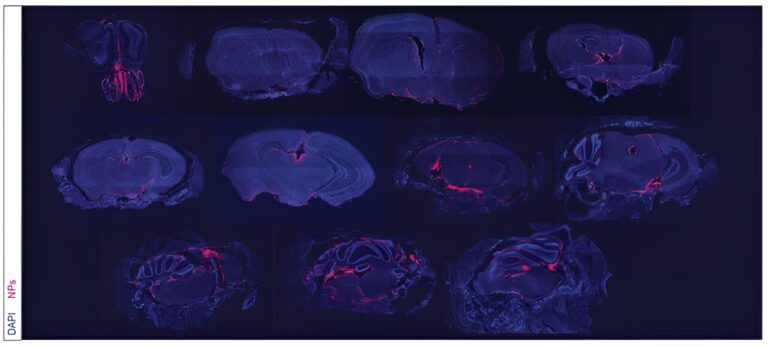 Nanoparticles ship remedy on to tumors of lethal mind most cancers